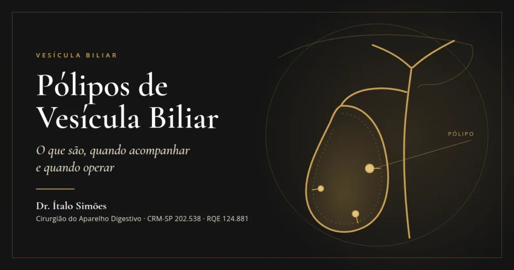 Ilustração da vesícula biliar com pólipos na parede interna — Dr. Ítalo Simões, cirurgião do aparelho digestivo em São Paulo